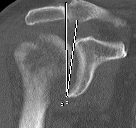 Glenoid Pre Rev TSR Coronal CT 2